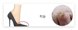티눈 예시 사진