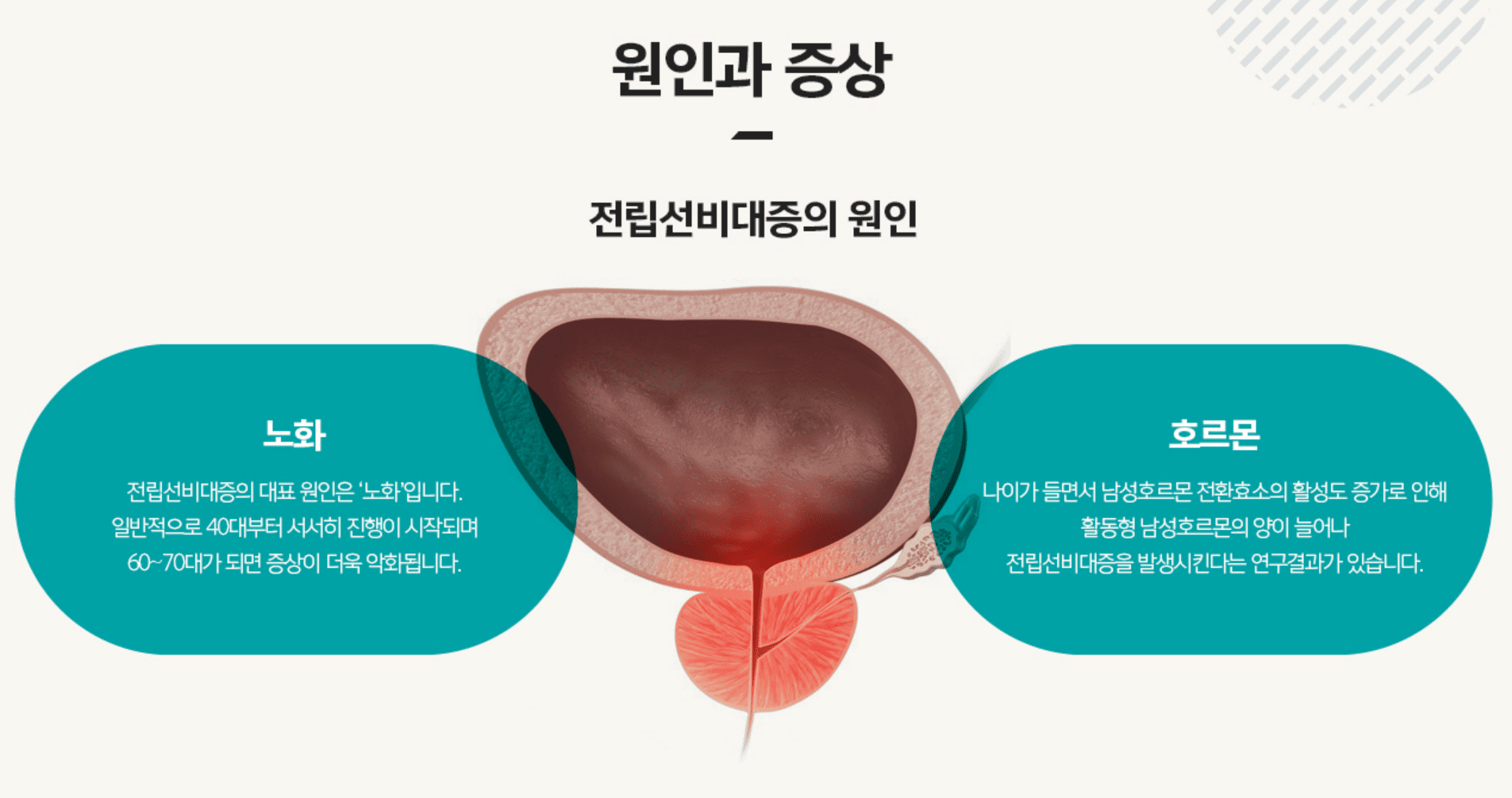 전립선비대증치료 전립선비대증수술비용 비뇨기과남성수술비용