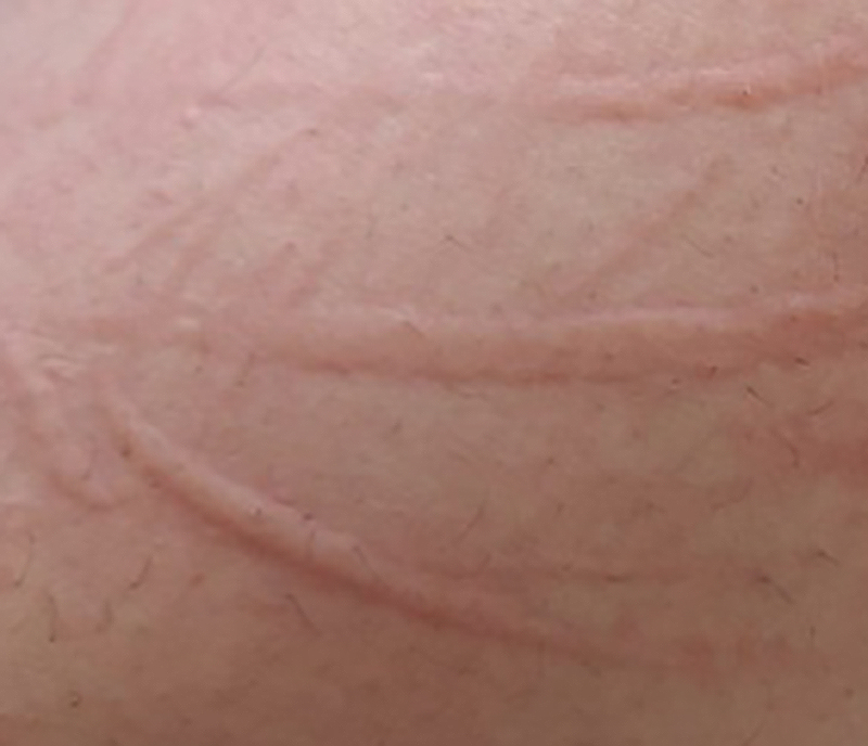 피부를 긁으면 그 자국대로 살이 부풀어 오르는 피부병의 모습