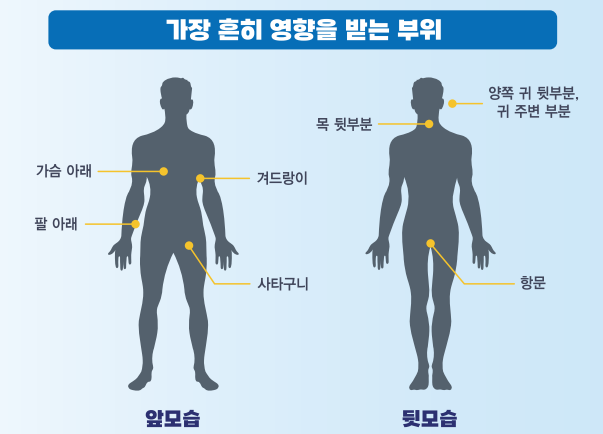 화농성 한선염 발병 위치