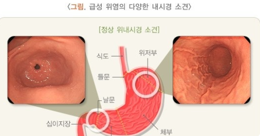 위염과 위궤양의 차이 및 예방법 관련 이미지