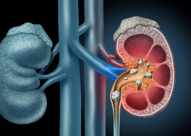 신장 결석 증상 4가지 및 신장 결석 파쇄기 체외충격파 쇄석술 비용 과정 총정리