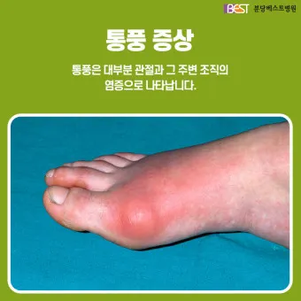발가락 통풍 증상 및 대처방법_6