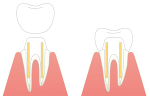 톱니가 아픈 이유
