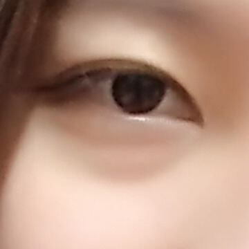 눈밑지방재배치 후기