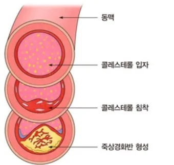 LDL 콜레스테롤 정상수치 낮추는법_4