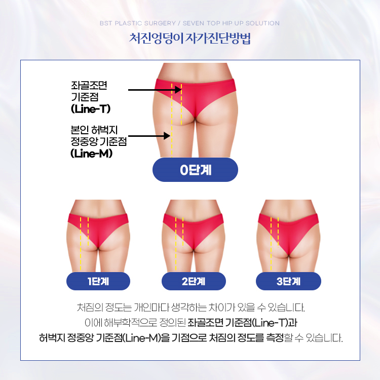 처진엉덩이 자가진단
처짐의 정도는 개인마다 생각하는 차이가 있을 수 있습니다. 해부학적으로 정의된 좌골조면 기준점과 허벅지 정중앙 기준점을 기점으로 처짐의 정도를 측정할 수 있습니다.