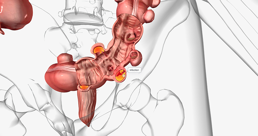 대장암 초기증상