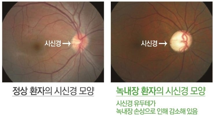 백내장 vs 녹내장, 조기 관리가 정말 중요합니다 관련 사진