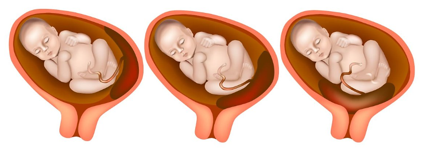 전치태반이란? 전치태반 뜻과 원인, 증상, 출산 방법 총정리