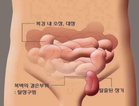 탈장
