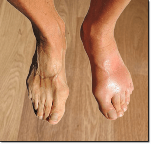 통풍에 좋은 베이킹소다