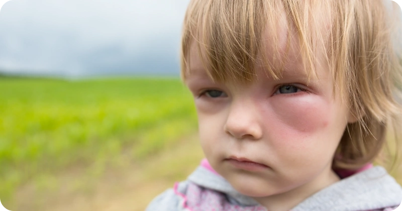 모기 물린 아이