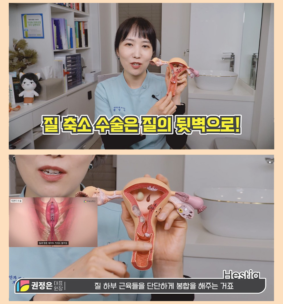 질축소수술,질성형수술,이쁜이수술 수술방법