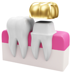 임플란트 가격 특징 정리