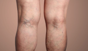 하지정맥류-수술비용