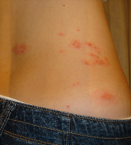 허리통증 대상포진