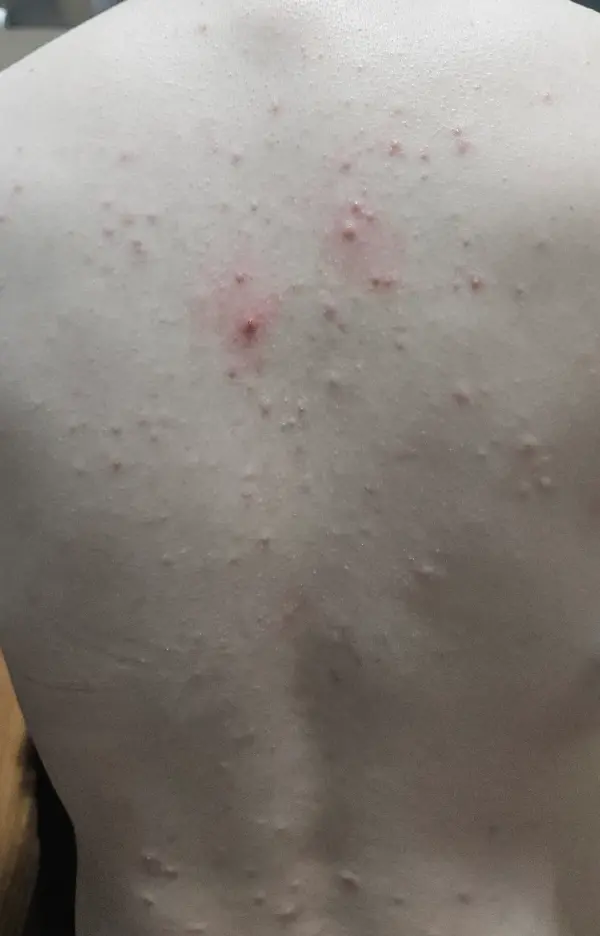 에스테틱 마사지 받은 후 생긴 등 여드름