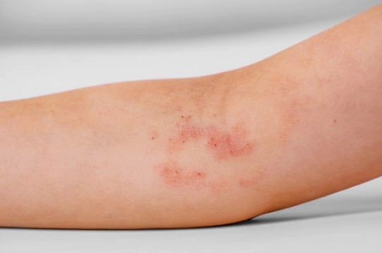 아토피 가려움증 해소방법 11가지