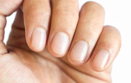 손톱 울퉁불퉁 갈라짐 반달 없음 건강 상태