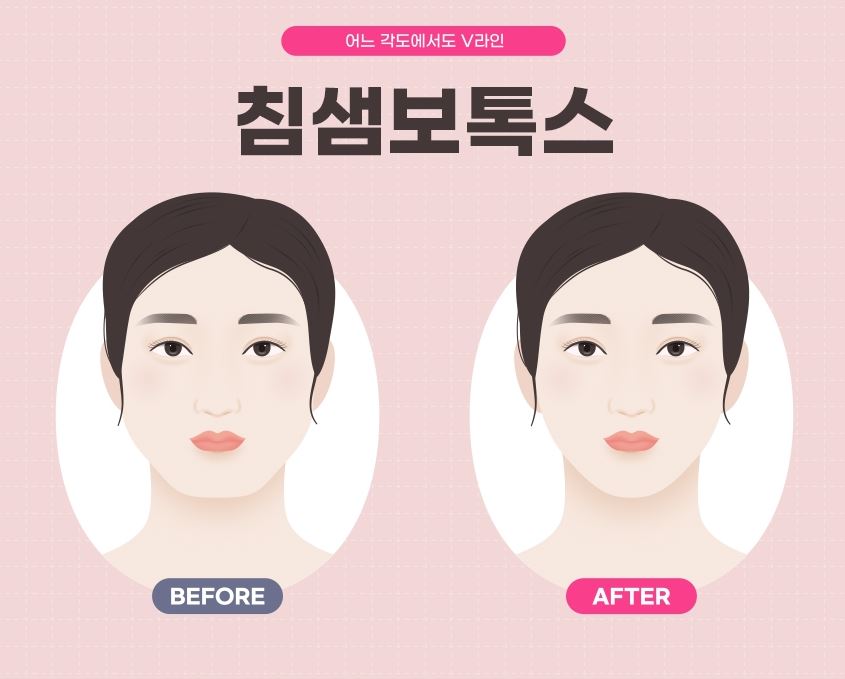 사각턱 보톡스