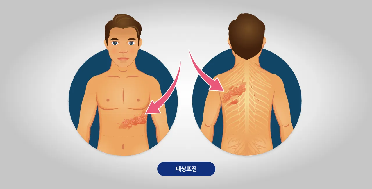 대상포진 병원어떤과로가나요