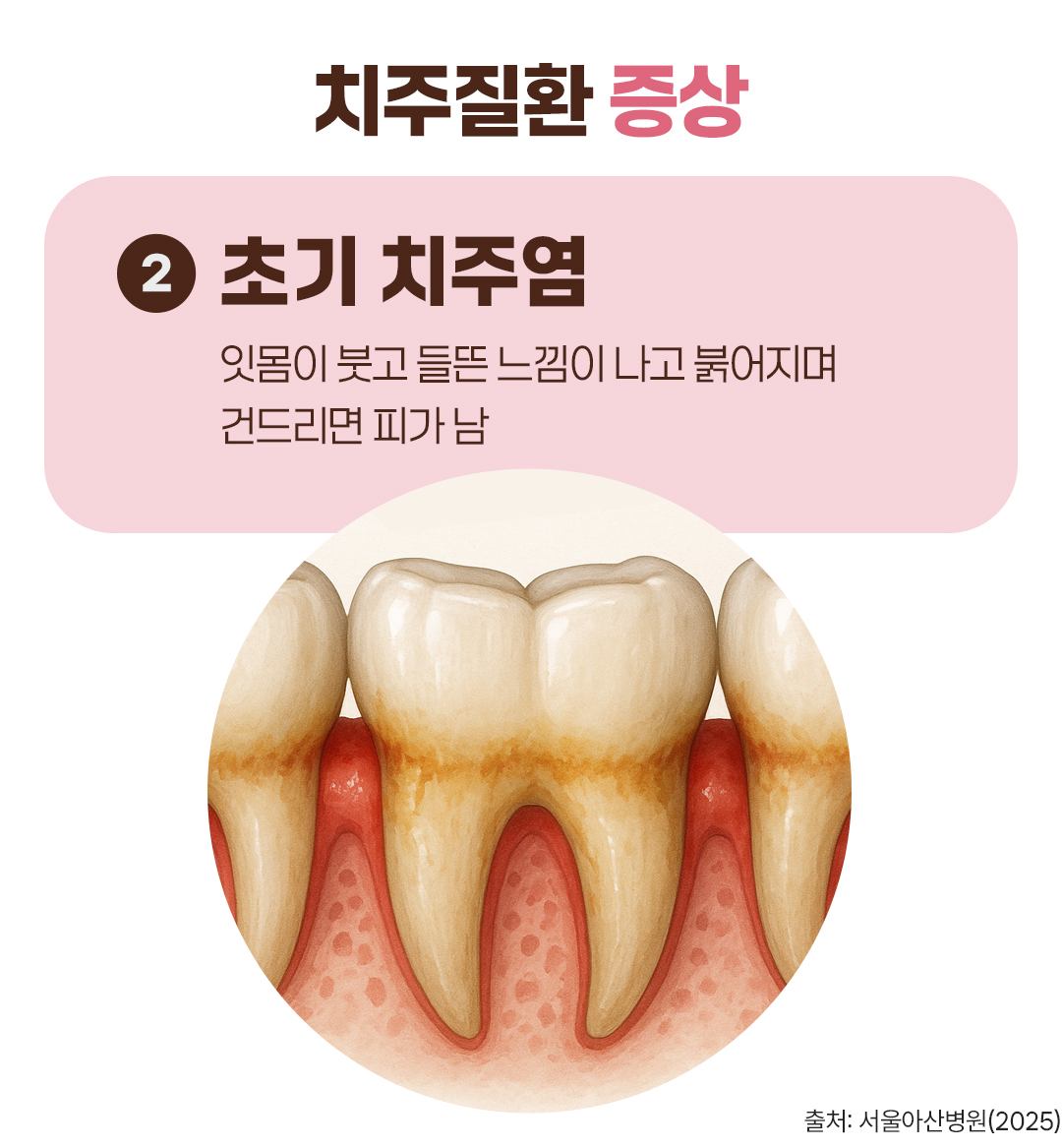 #치주질환 증상 #초기 치주염 #잇몸이 붓고 들뜬 느낌이 나고 붉어지며 건드리면 피가 남
