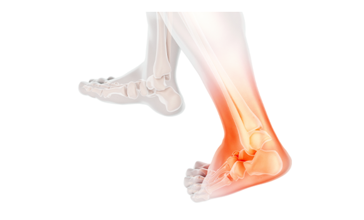 발목 염좌 원인