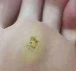 사마귀 원인과 제거방법