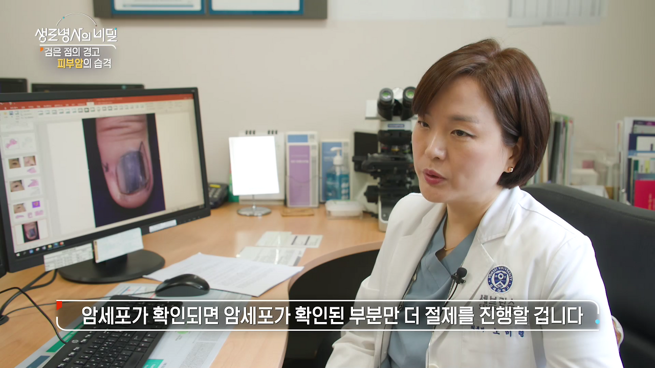 생로병사의 비밀 피부암 검은점