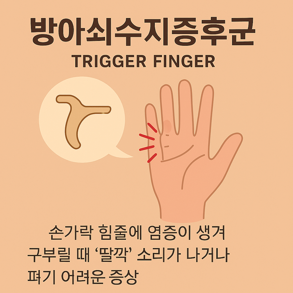 방아쇠수지증후군 손가락 관절 굳는증상