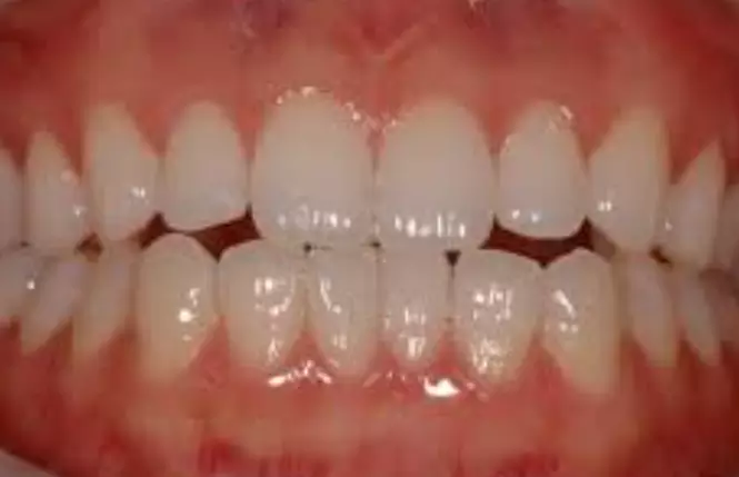 베타-시토스테롤-효능-부작용-건강