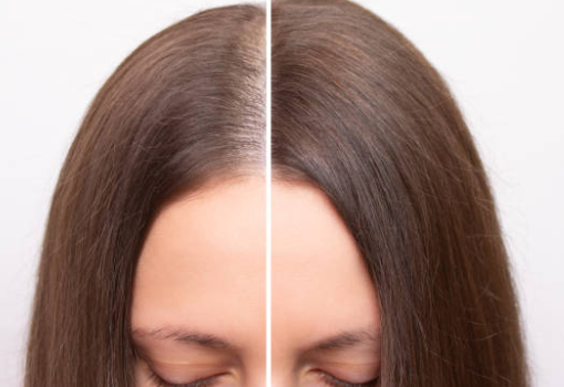 탈모 중 사람들의 시선, 내가 대처한 방법들