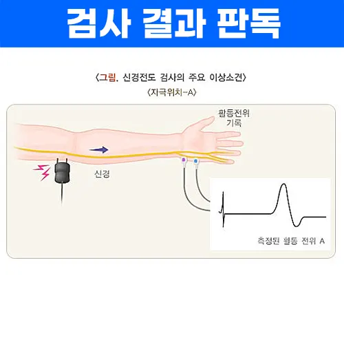 근전도 검사 결과