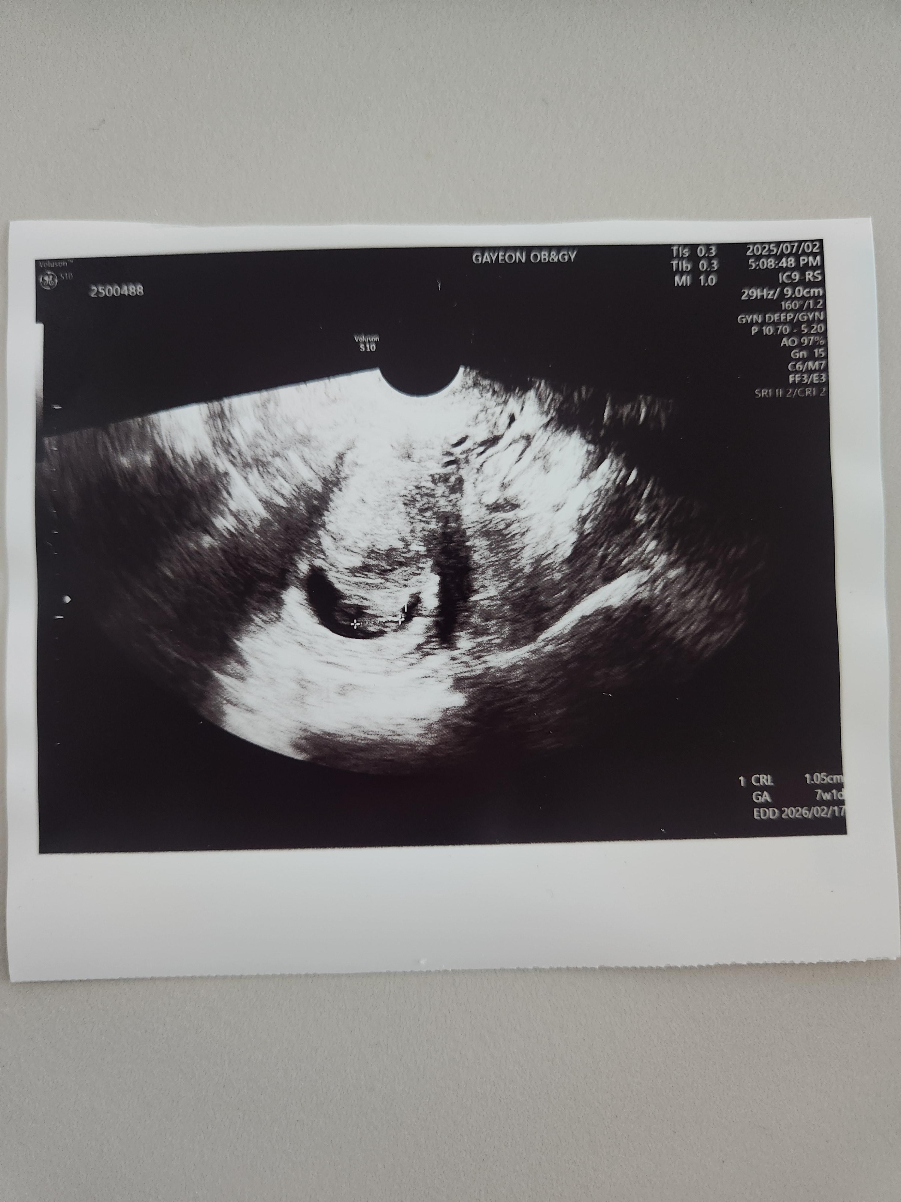 임신7주차, 임신7주1일차 초음파