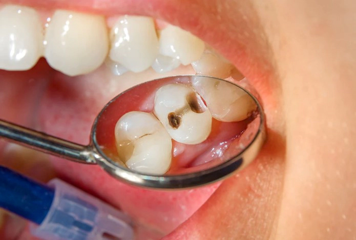 치아 우식증 예방법 10가지 및 치아 우식단계별 증상 치료 총정리