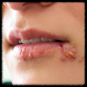 입술 수포 구순포진