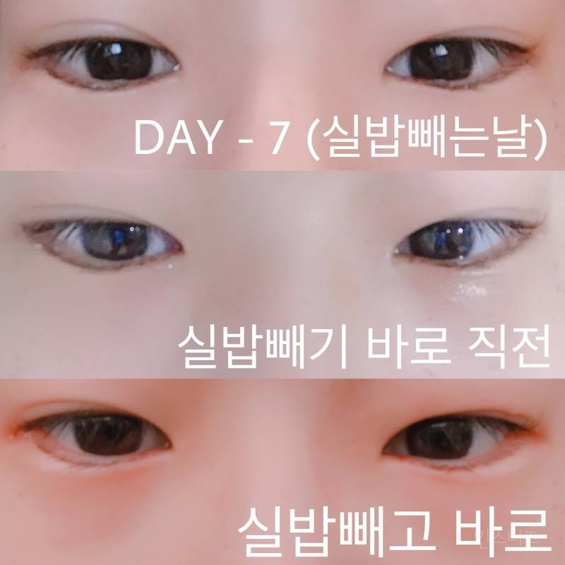안검내반수술 후기