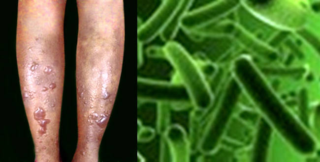 비브리오패혈증 증상&amp;#44; 예방법부터 치사율까지 총정리