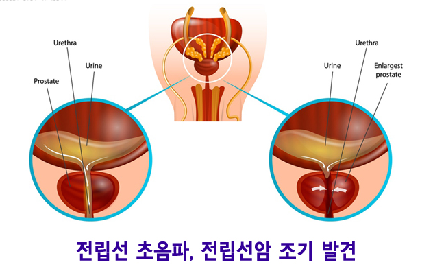전립선암 조기 발견의 중요성 관련 이미지