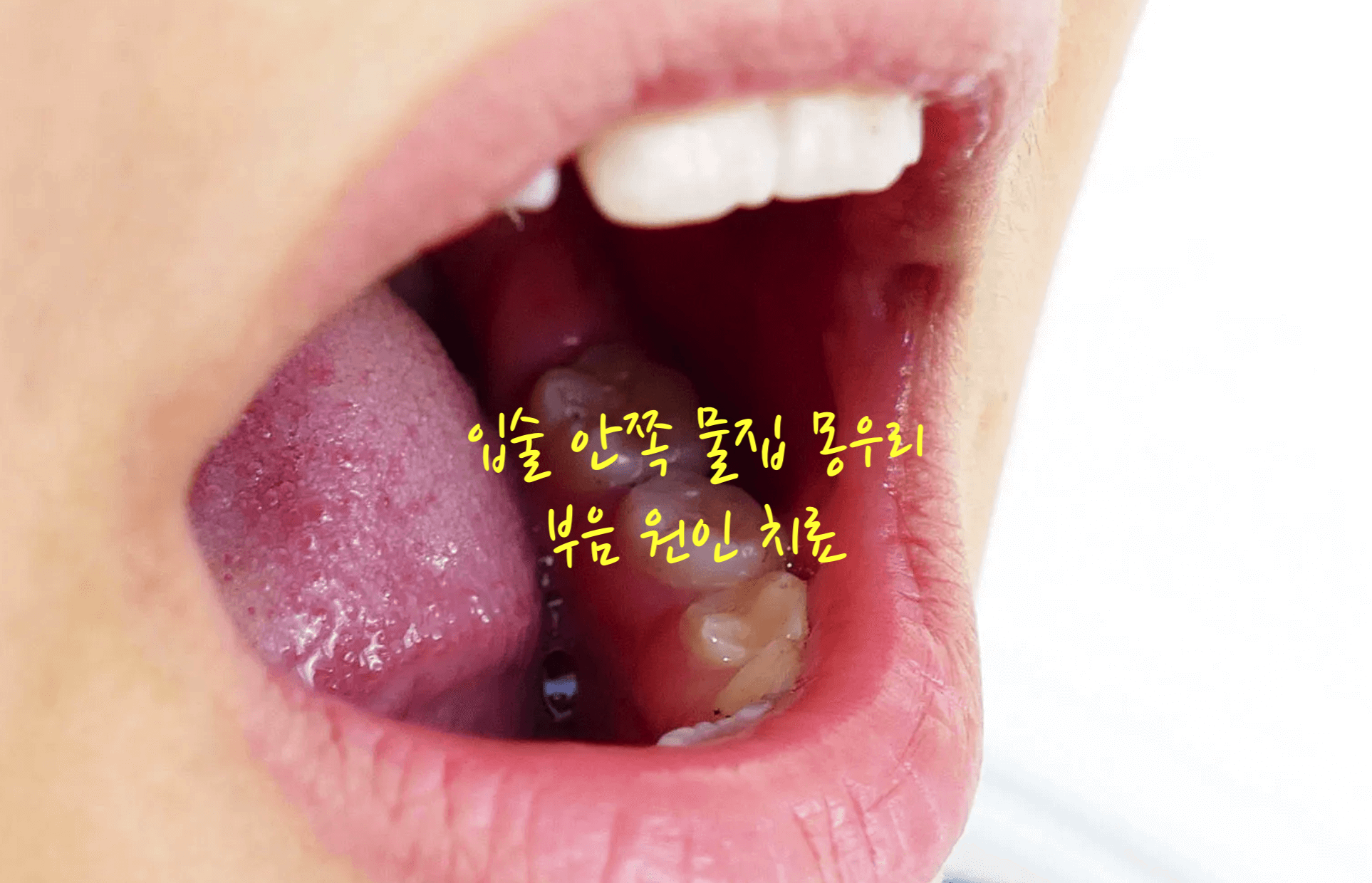 입술 안쪽 물집