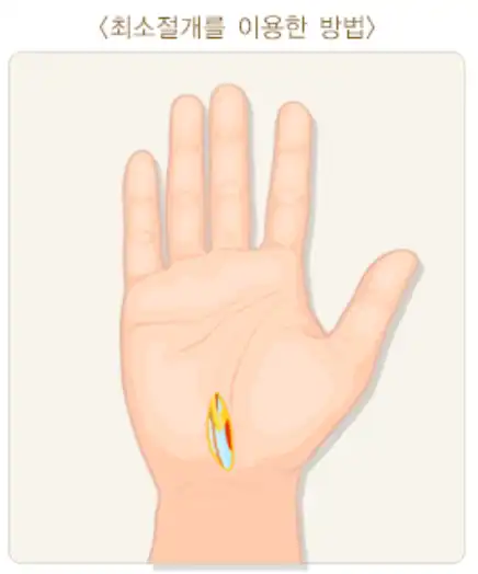 손목터널증후군-최소절개-이미지