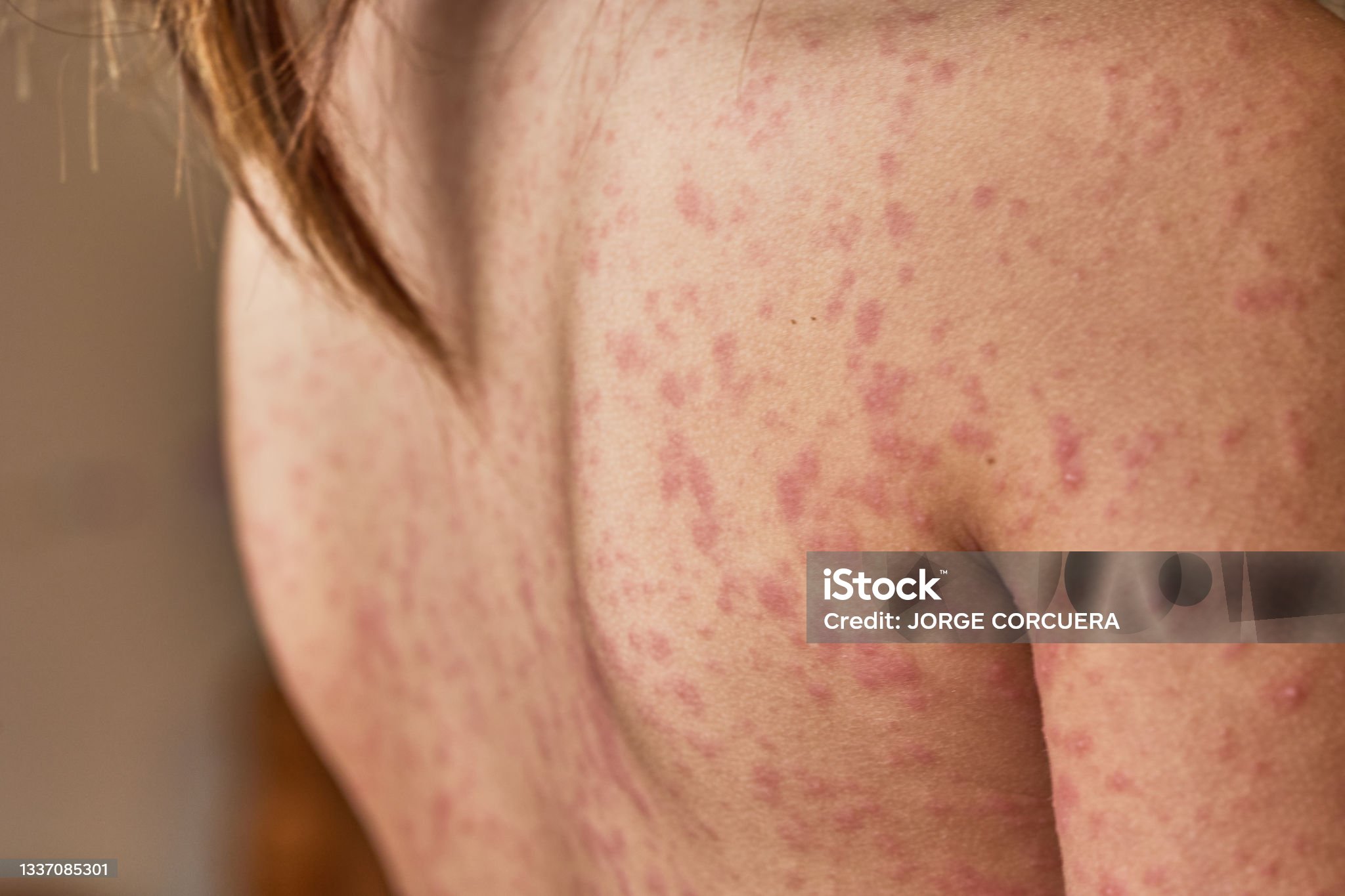 장미색 비강진 관련 사진