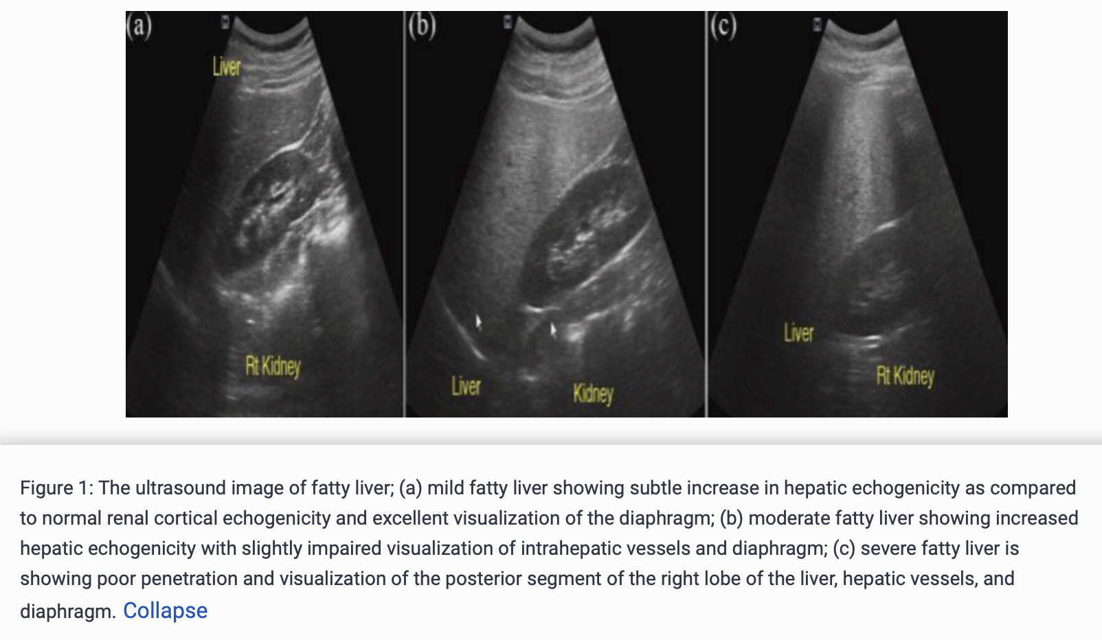 fatty liver grade