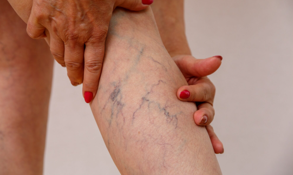 하지정맥류 원인