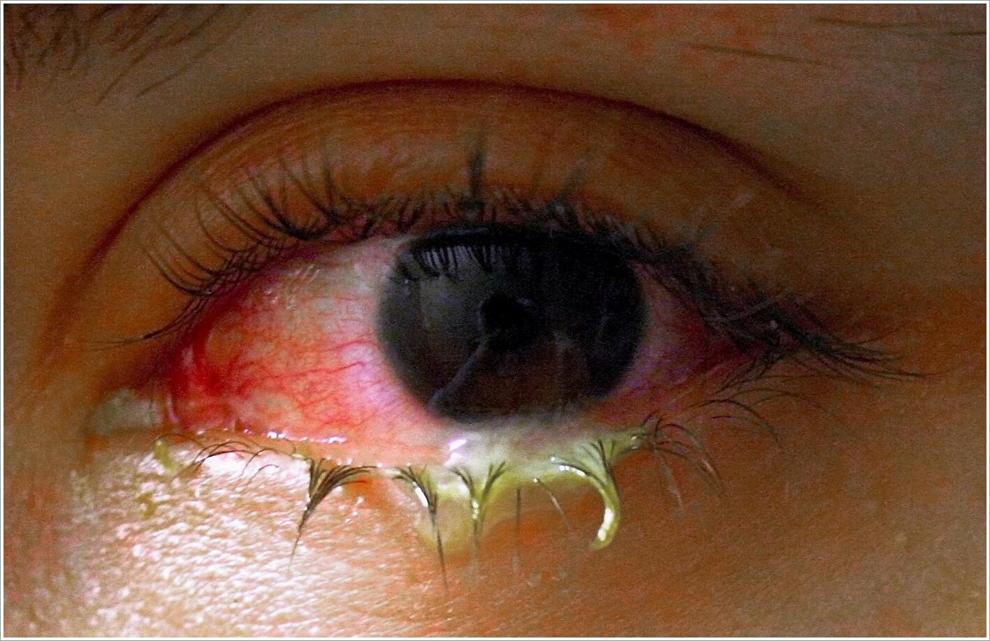 대상포진 초기증상