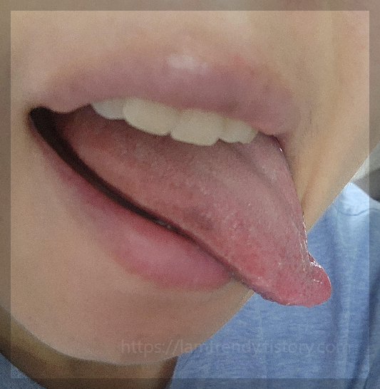 혀에 검은 점 초기 증상 옅에 점이 있음