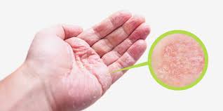 온몸이 가려운 증상