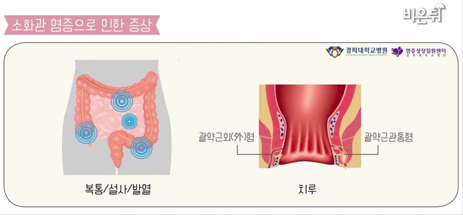 크론병 증상