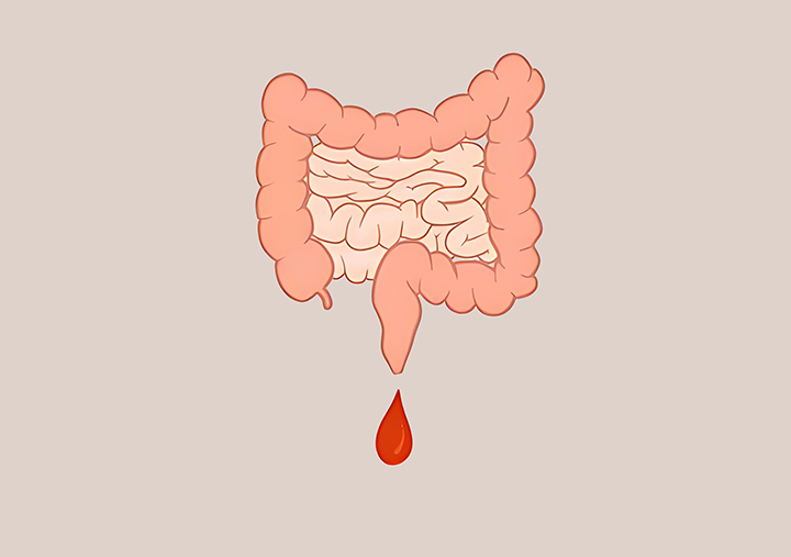 출혈이-있는-항문